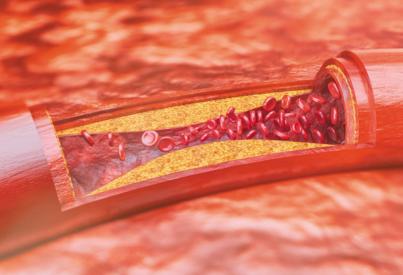 CAP & atherosclerosis / vessel block