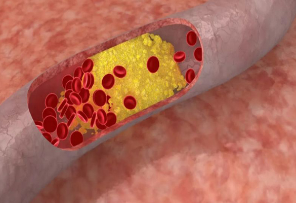 CAP for reducing triglycerides