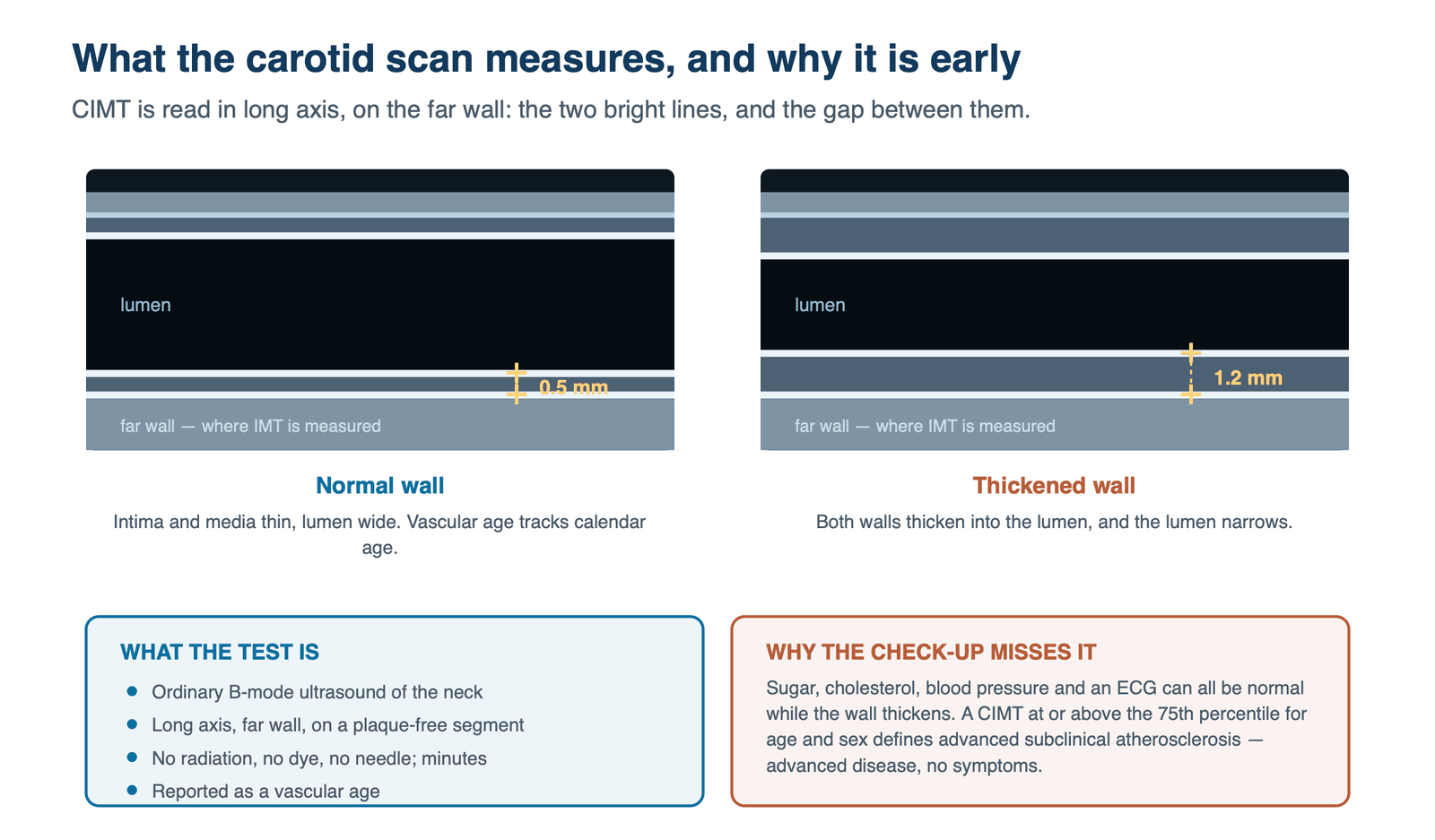 Two long-axis carotid ultrasound panels side by side. In the normal wall the intima and media are thin and the lumen is wide; in the thickened wall both the near and the far wall have built inwards and the lumen is visibly narrower. Calipers on the far wall read 0.5 mm and 1.2 mm.